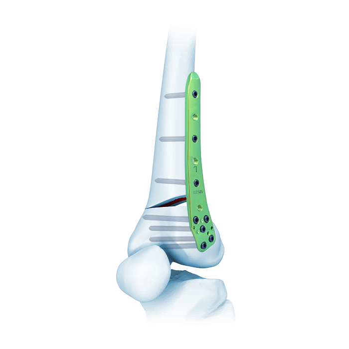 Placa TomoFix® para fémur distal lateral