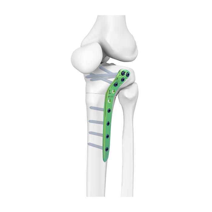 Placa para tibia lateral proximal Synthes