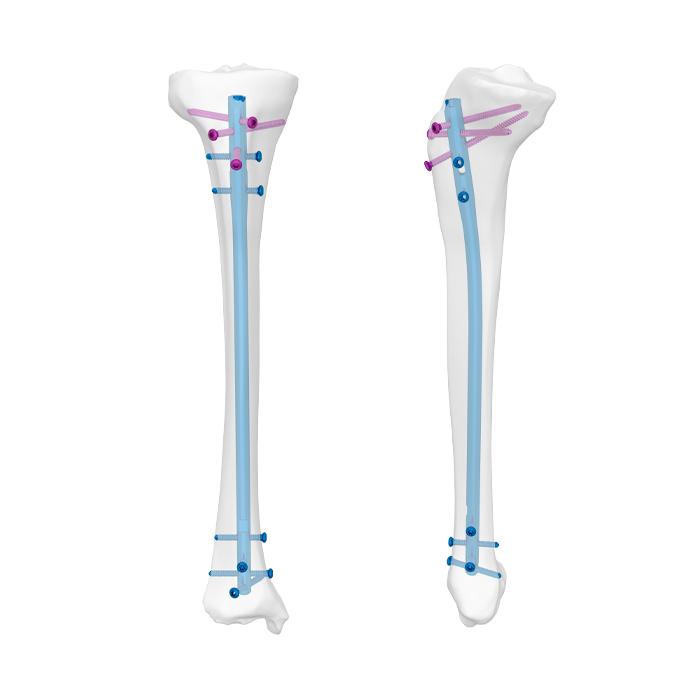 Predictores de fallo temprano en la osteosíntesis con clavo Multilock recto  en las fracturas de húmero proximal de dos fragmen