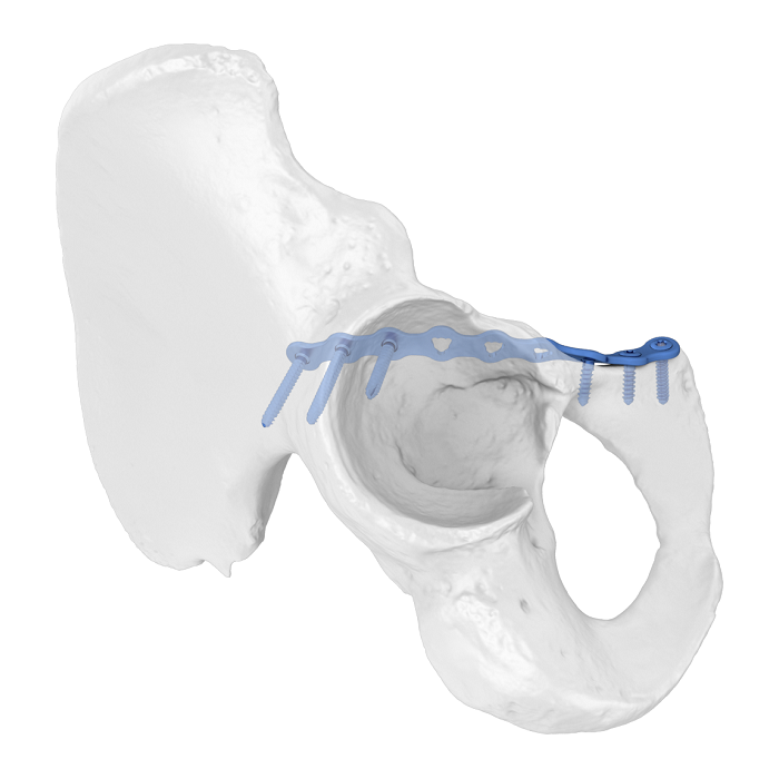 Sistema de placa acetabular flexible (FAP) Placa de bloqueo anatómica de la línea anterior iliopúbica
