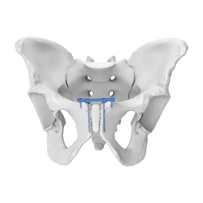 Sistema de placa acetabular flexible (FAP) Sínfisis púbica Placa de bloqueo anatómica superior
