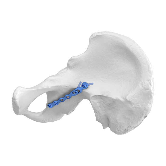 Sistema de placa acetabular flexible (FAP) Placa de bloqueo anatómica iliociática, oblicua

