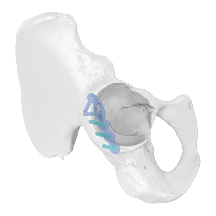Sistema de placa acetabular flexible (FAP) Placa de bloqueo anatómica iliociática
