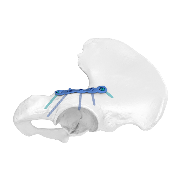 Sistema de placa acetabular flexible (FAP) Columna posterior Placa anatómica de bloqueo
