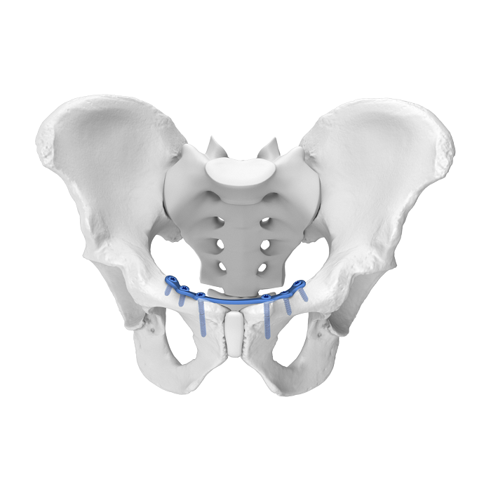 Sistema de placa acetabular flexible (FAP) Placa de bloqueo anatómica medial para sínfisis púbica
