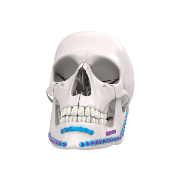 Mandible Plating System