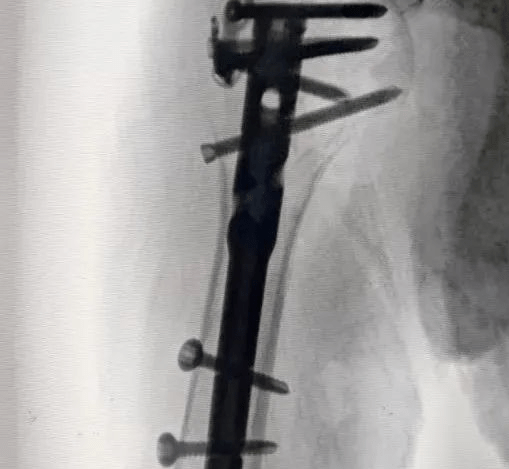 Uso compartido de casos: el primer clavo intramedular con bola de copa humeral para fractura de húmero proximal en China