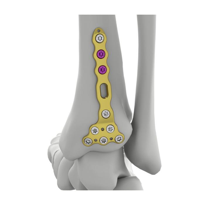 Placa de bloqueo tibial posterior distal Itval