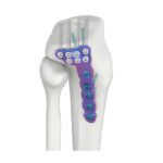 VAL Placa de bloqueo DR tibial lateral proximal