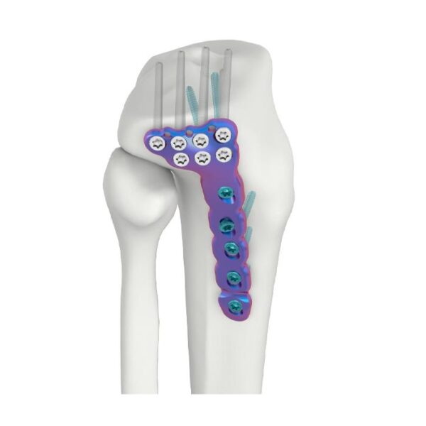 VAL Placa de bloqueo DR tibial lateral proximal