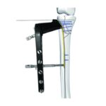 Placa de Bloqueo de Contrafuerte para Cabeza Tibial Lateral Ⅱ