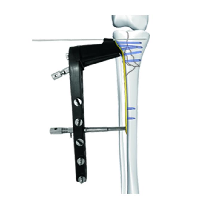 Placa de Bloqueo de Contrafuerte para Cabeza Tibial Lateral Ⅱ