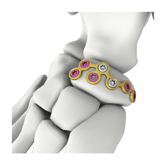 Placa de bloqueo para navicular Itval