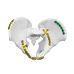 Placa anterior para la articulación sacroiliaca