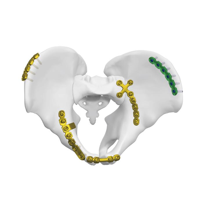 Placa anterior para la articulación sacroiliaca