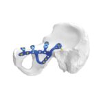 Placa de bloqueo acetabular pélvica anatómica
