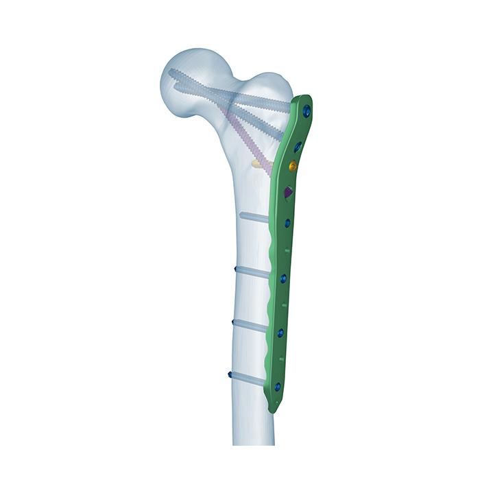 Placa de bloqueo femoral proximal