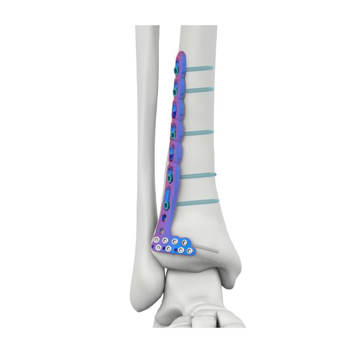 VAL Placa de bloqueo tibial lateral anterior distal