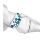 Placa de bloqueo navicular para MT