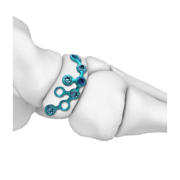 Placa de bloqueo navicular para MT
