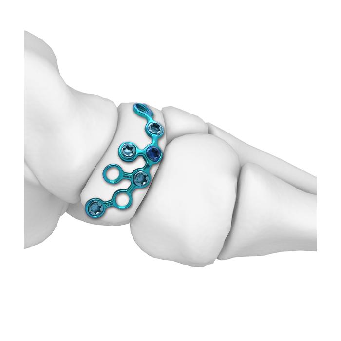 Placa de bloqueo navicular para MT