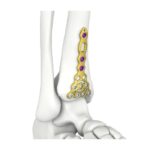 Placa de Bloqueo Tibial Anterior Distal Itval