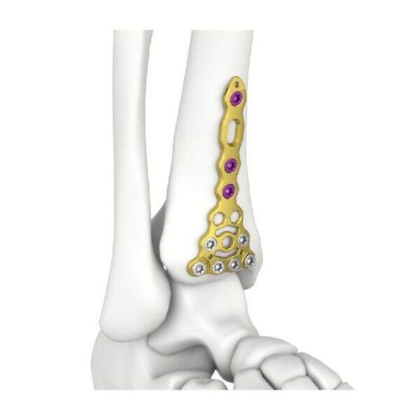 Placa de Bloqueo Tibial Anterior Distal Itval