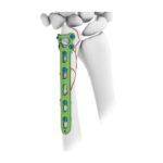 Placa de bloqueo ulnar distal