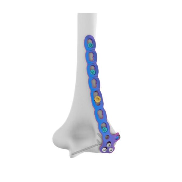 VAL Placa de bloqueo humeral distal lateral