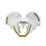 Placa ilioinguinal anatómica