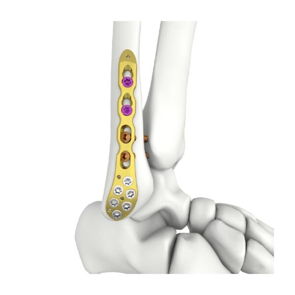 Placa de Bloqueo Fibular Lateral Distal Itval