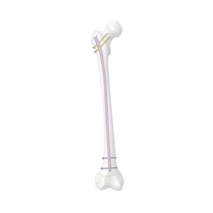 Sistema de clavos femorales para adolescentes