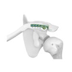 Placa de bloqueo con gancho clavicular II